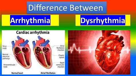 arrhythmia vs dysrhythmia examples